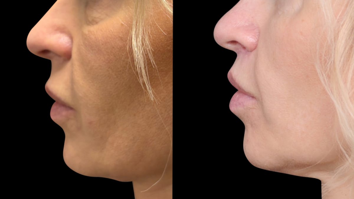 Lip Lift Before & After Gallery - Patient 267046 - Image 3