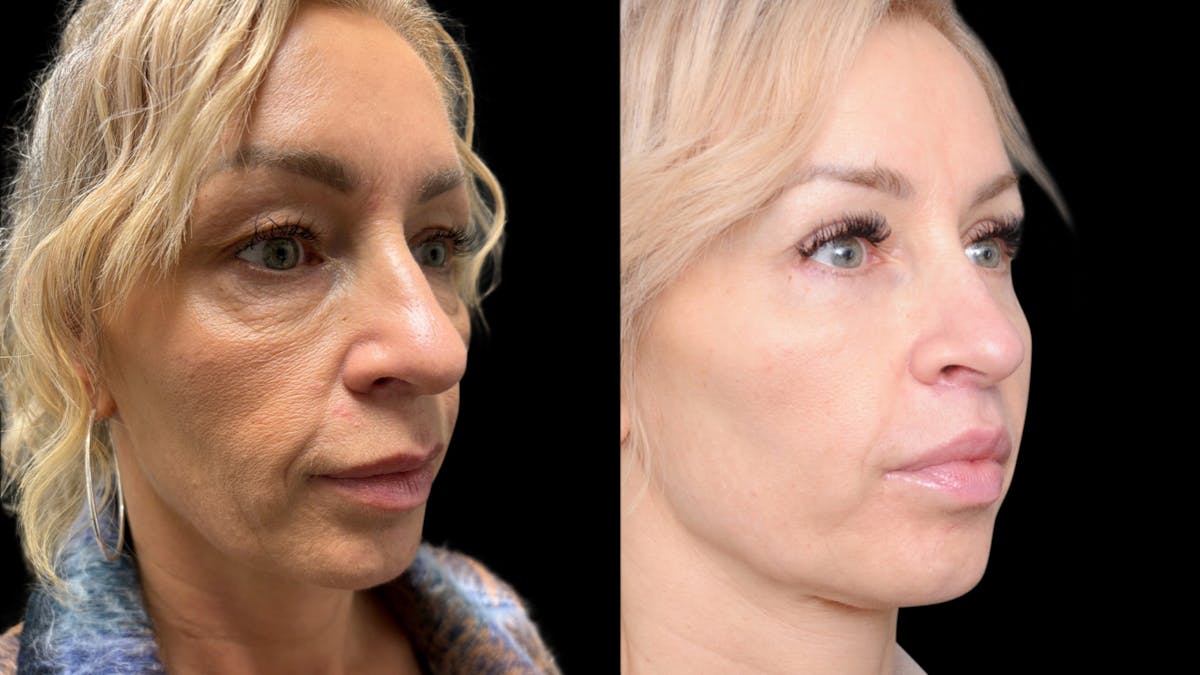 Lip Lift Before & After Gallery - Patient 267046 - Image 6