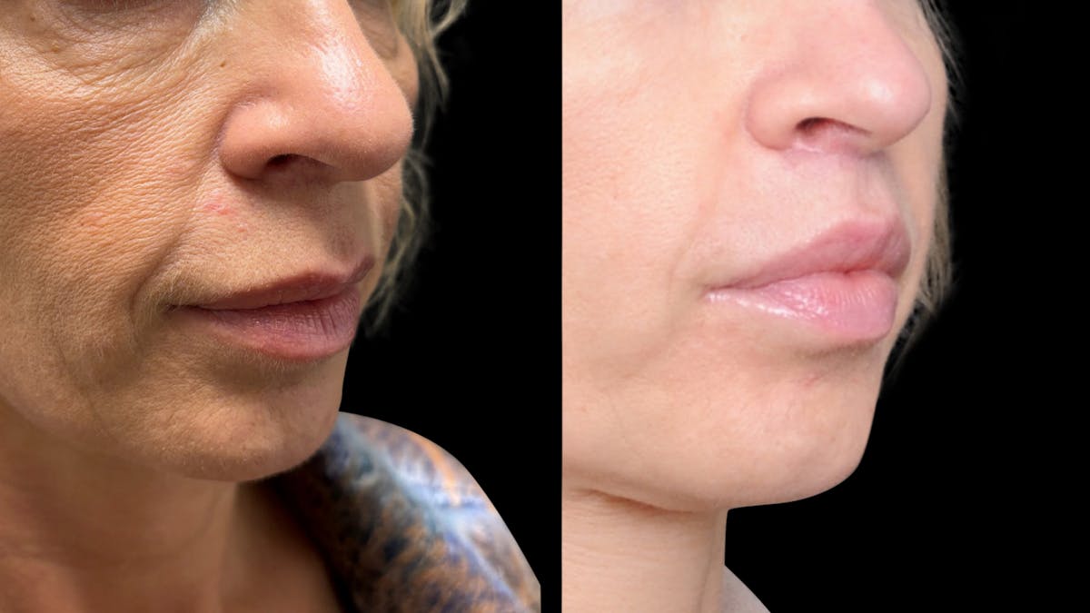 Lip Lift Before & After Gallery - Patient 267046 - Image 7