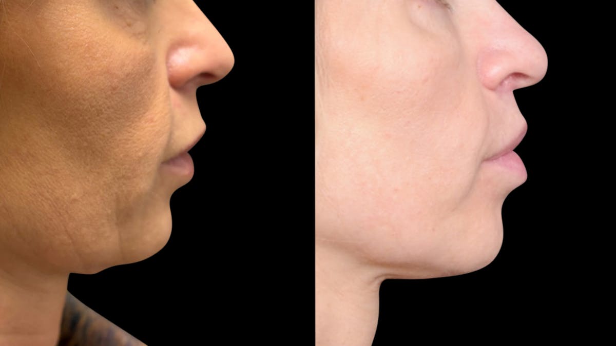 Lip Lift Before & After Gallery - Patient 267046 - Image 8