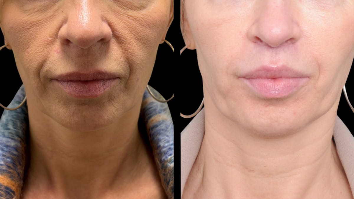 Lip Lift Before & After Gallery - Patient 267046 - Image 5