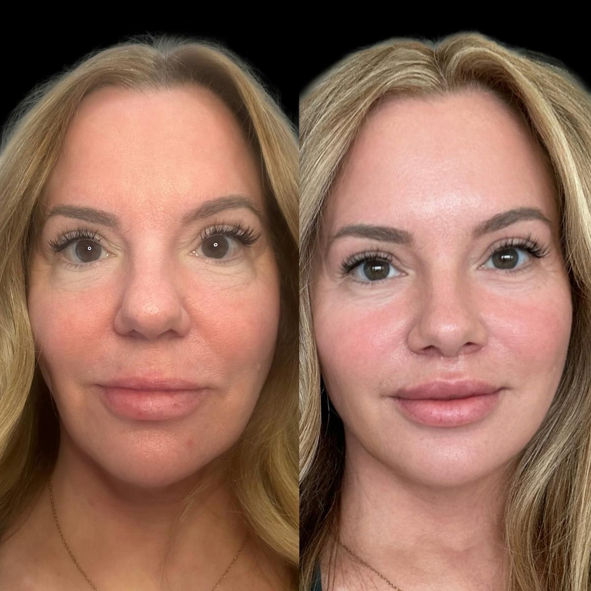 Mini Facelift Before & After Gallery - Patient 143909 - Image 3