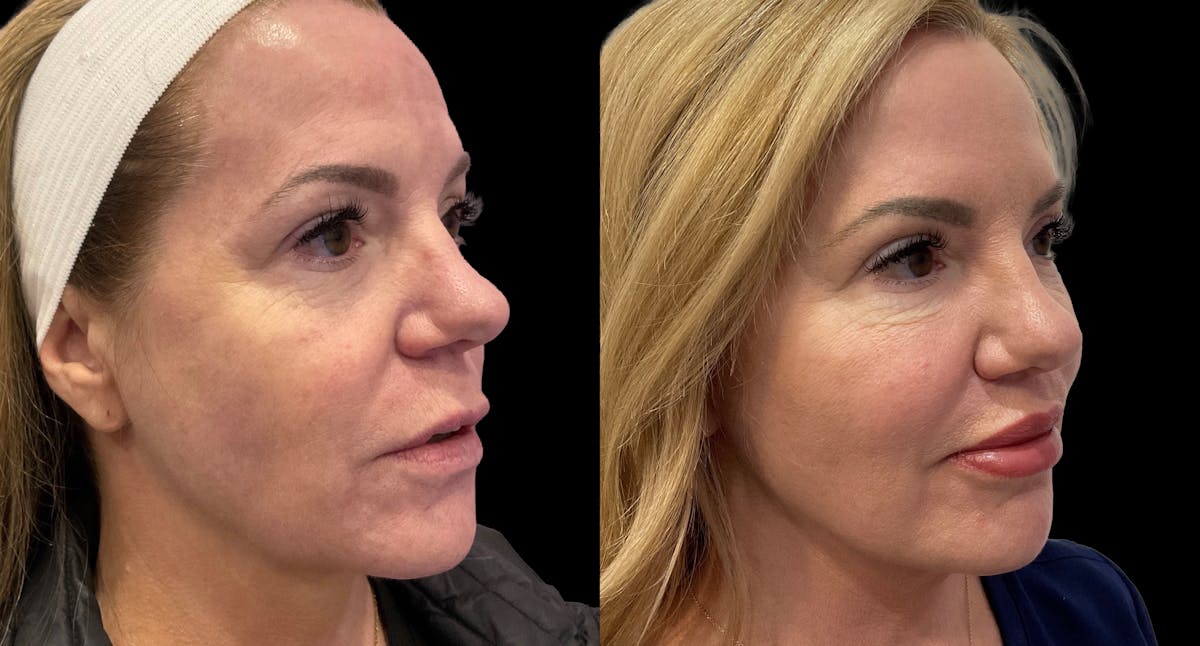 Mini Facelift Before & After Gallery - Patient 143909 - Image 2