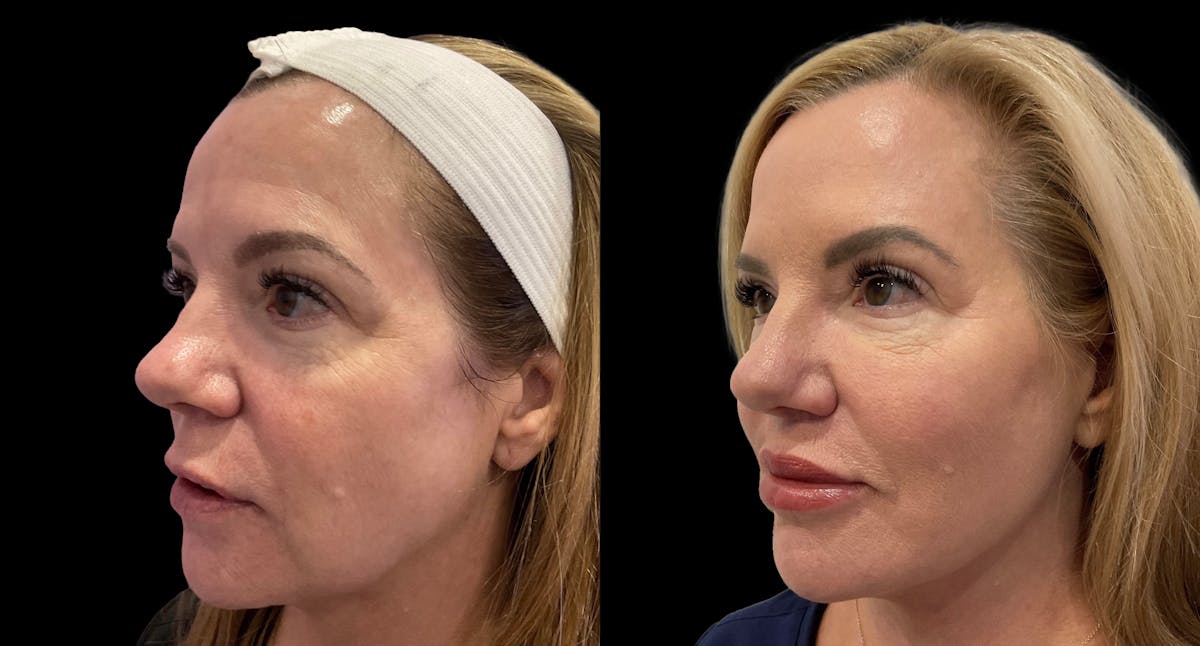 Mini Facelift Before & After Gallery - Patient 143909 - Image 4