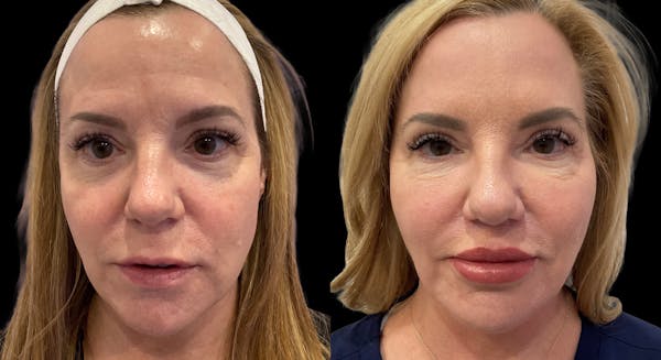 Mini Facelift Before & After Gallery - Patient 143909 - Image 1