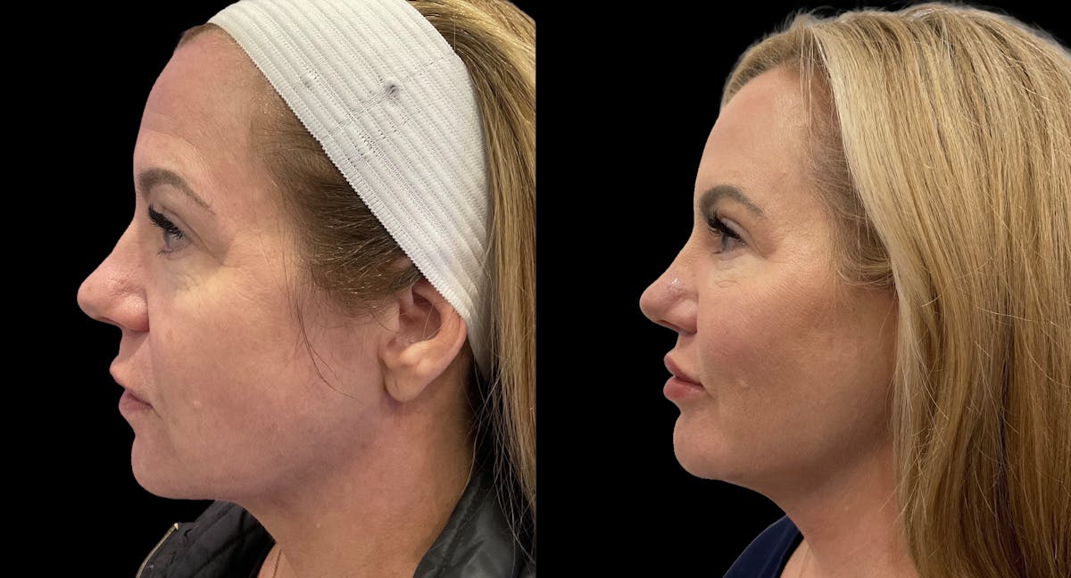Mini Facelift Before & After Gallery - Patient 143909 - Image 5