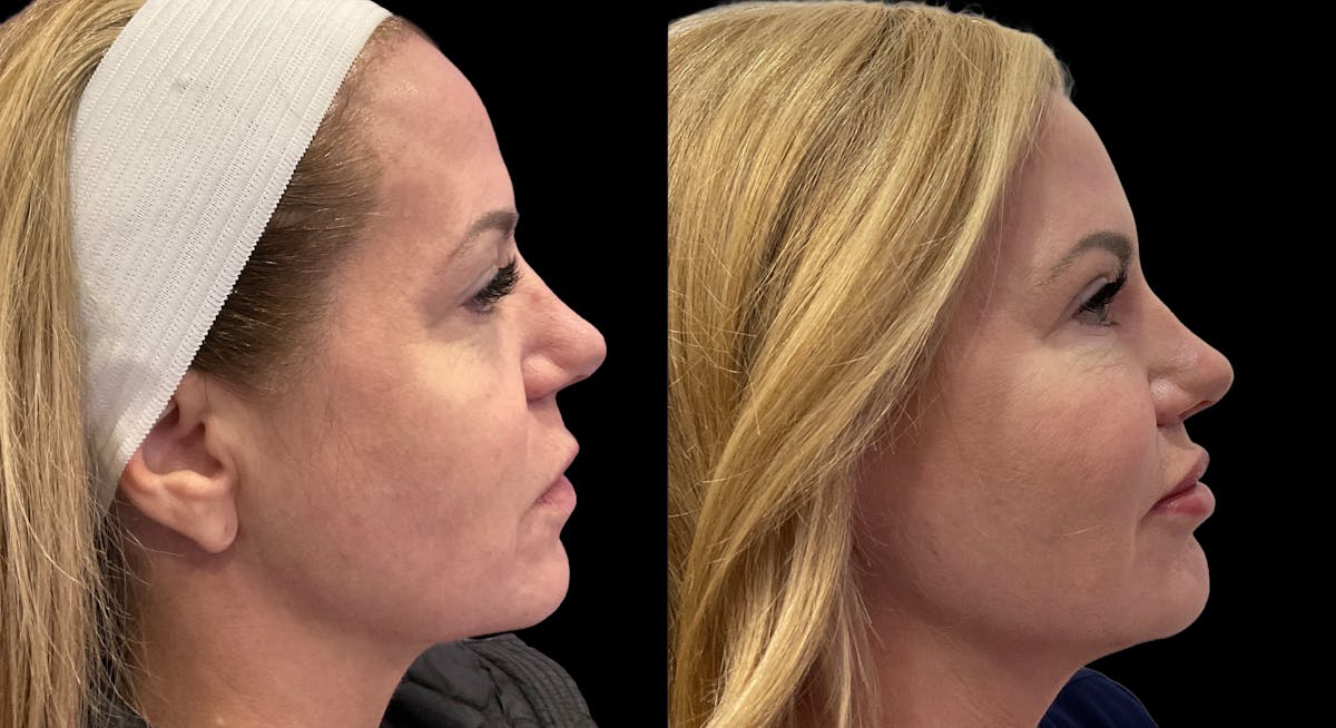 Mini Facelift Before & After Gallery - Patient 143909 - Image 6