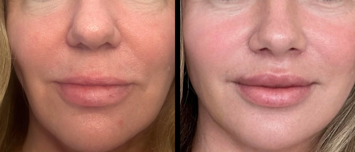 Mini Facelift Before & After Gallery - Patient 143909 - Image 7