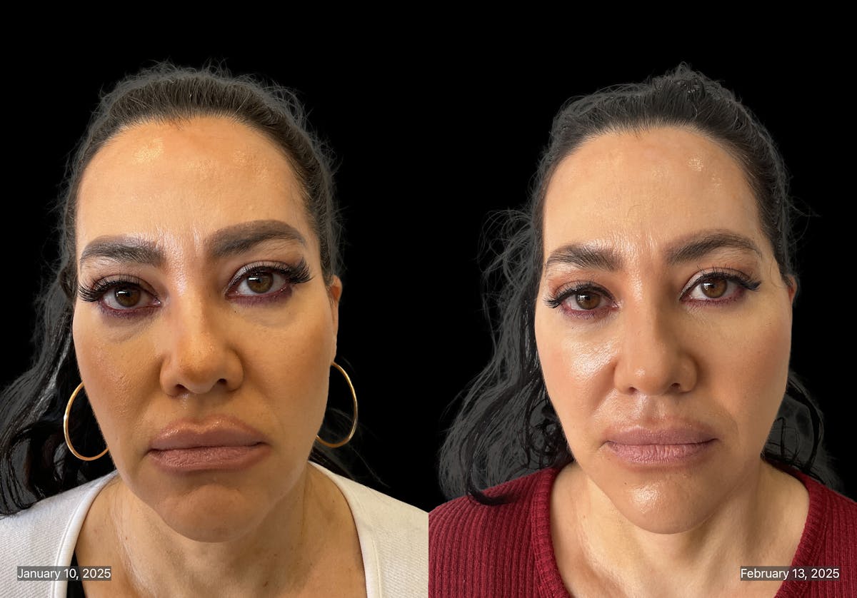 Mini Facelift Before & After Gallery - Patient 412333 - Image 1