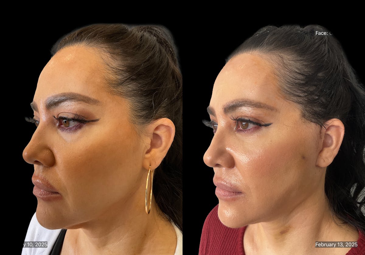Mini Facelift Before & After Gallery - Patient 412333 - Image 2