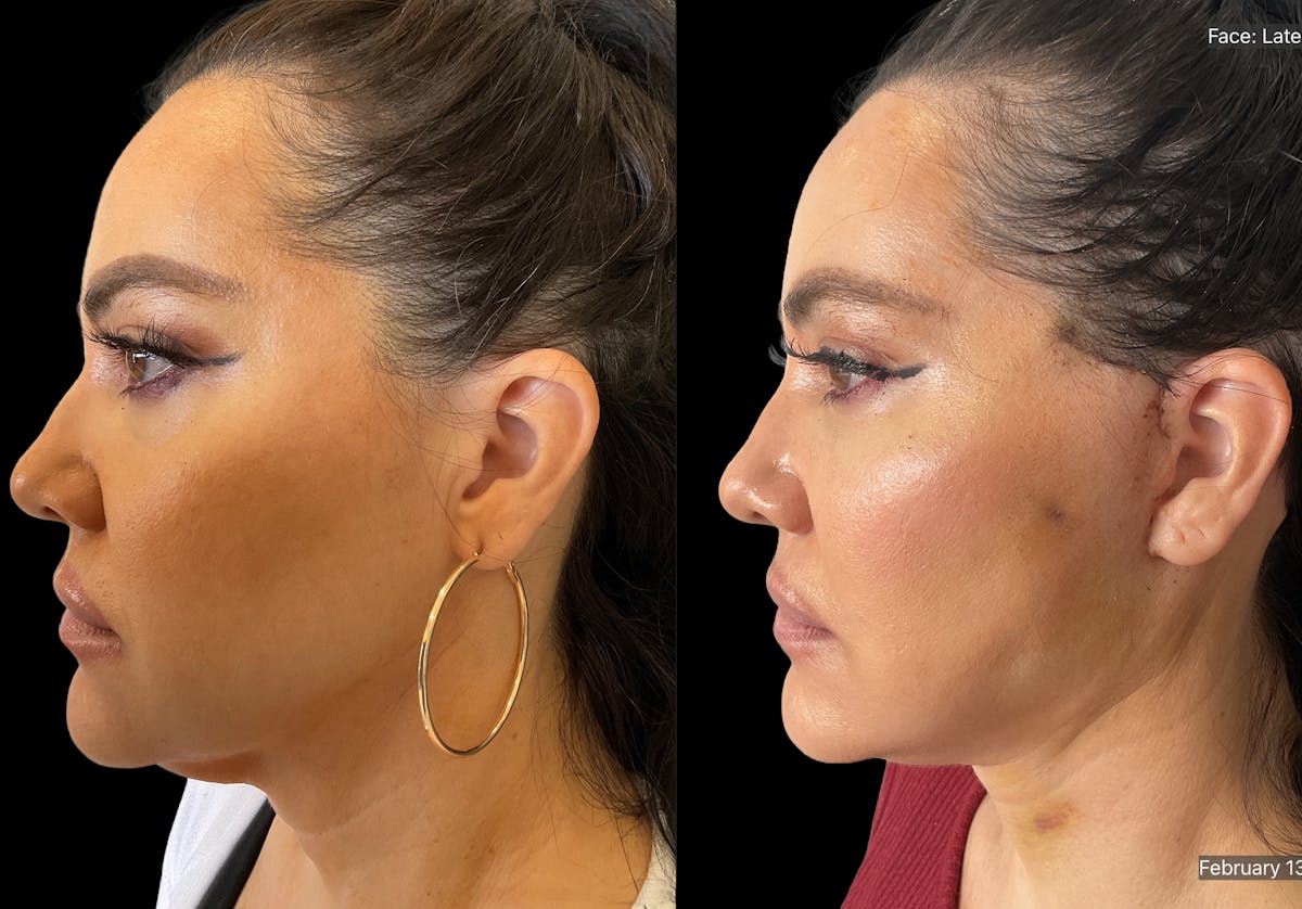 Mini Facelift Before & After Gallery - Patient 412333 - Image 3