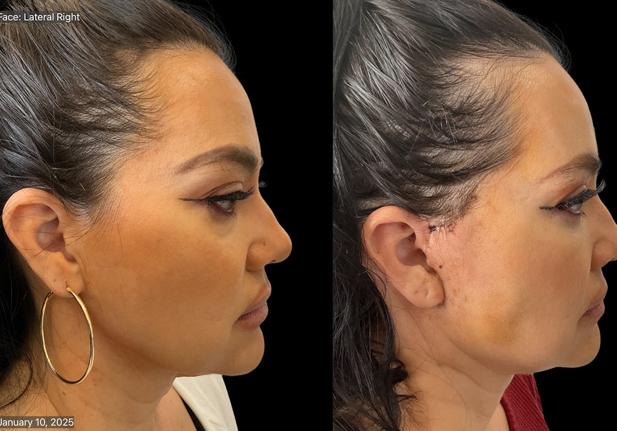 Mini Facelift Before & After Gallery - Patient 412333 - Image 4