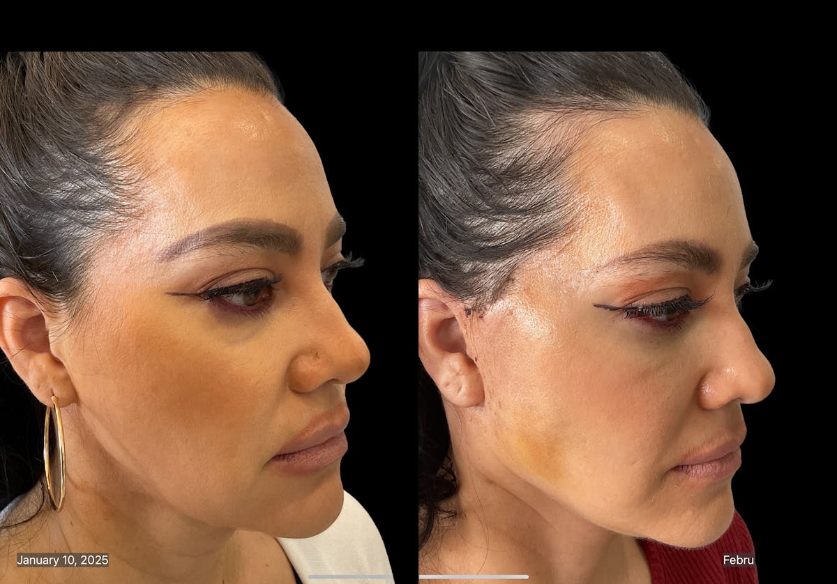 Mini Facelift Before & After Gallery - Patient 412333 - Image 5