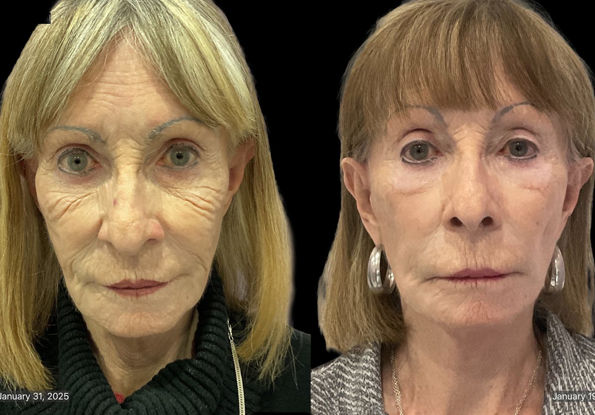 Mini Facelift Before & After Gallery - Patient 409348 - Image 1