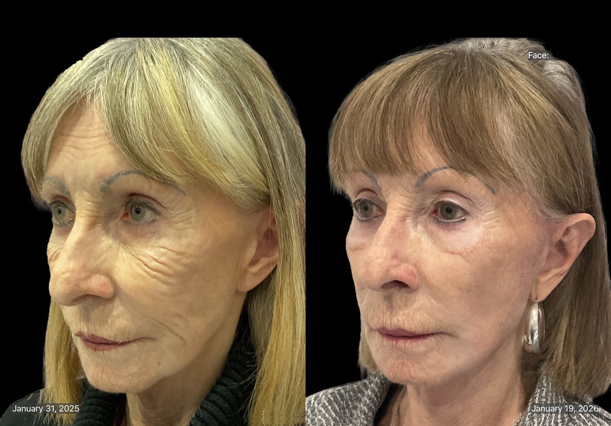 Mini Facelift Before & After Gallery - Patient 409348 - Image 2