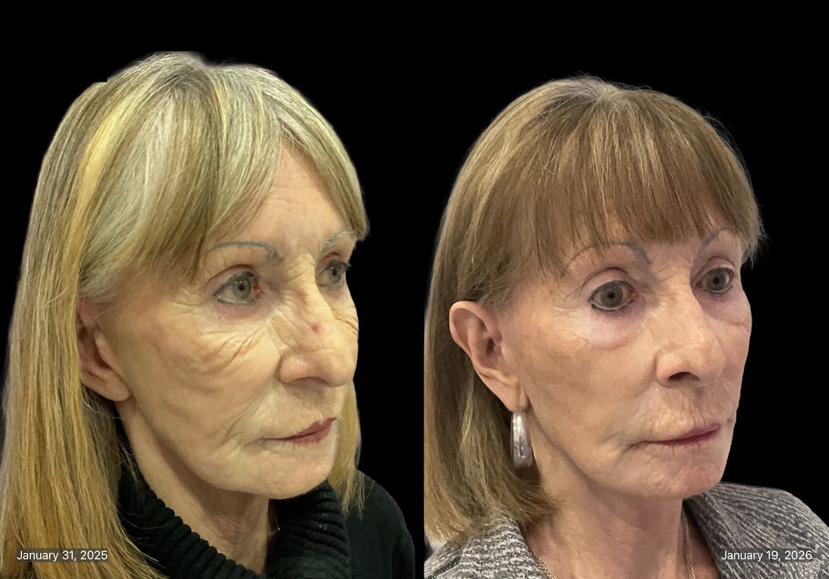 Mini Facelift Before & After Gallery - Patient 409348 - Image 3