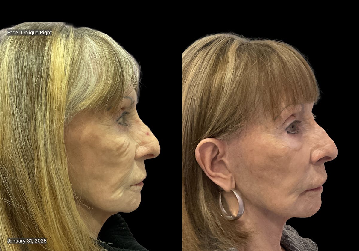 Mini Facelift Before & After Gallery - Patient 409348 - Image 4