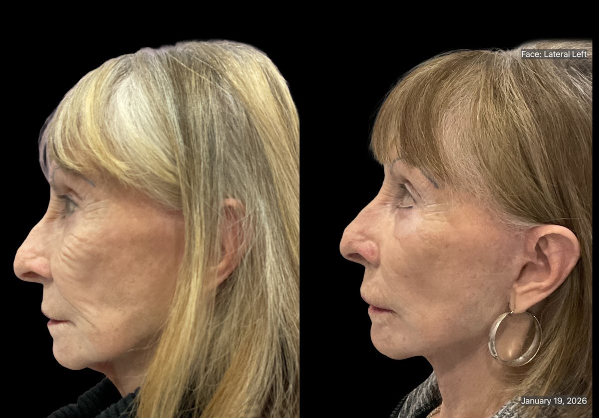 Mini Facelift Before & After Gallery - Patient 409348 - Image 5