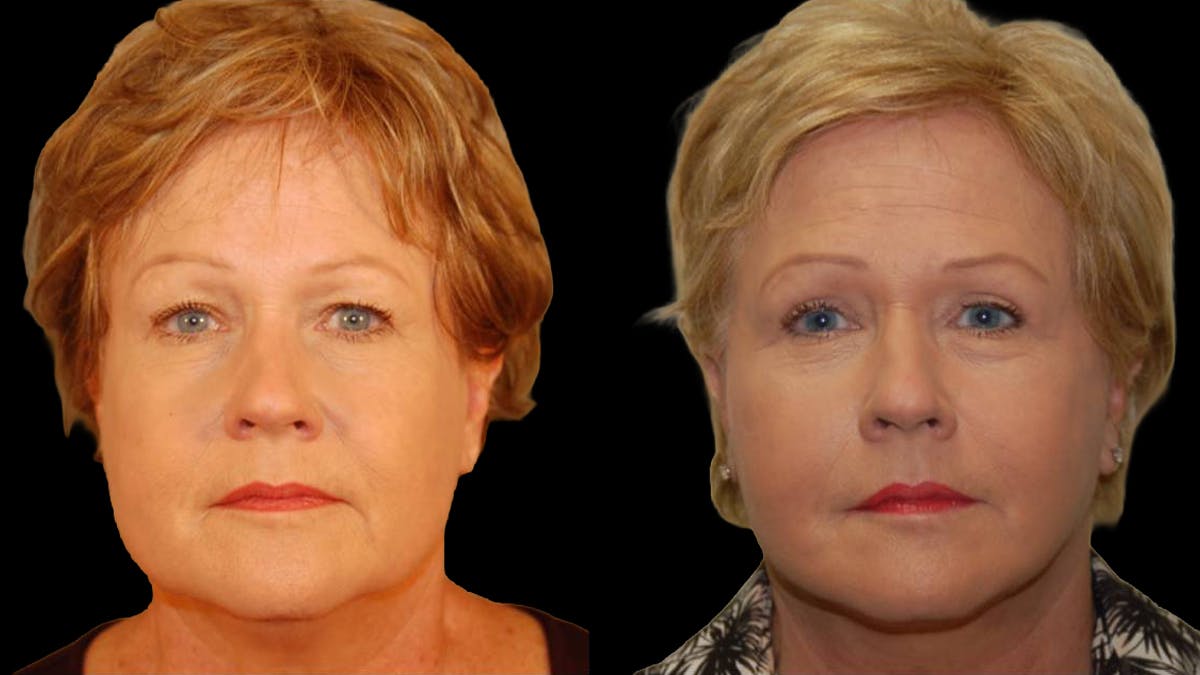 Mini Facelift Before & After Gallery - Patient 352097 - Image 1