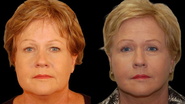 Mini Facelift Before & After Gallery - Patient 352097 - Image 1