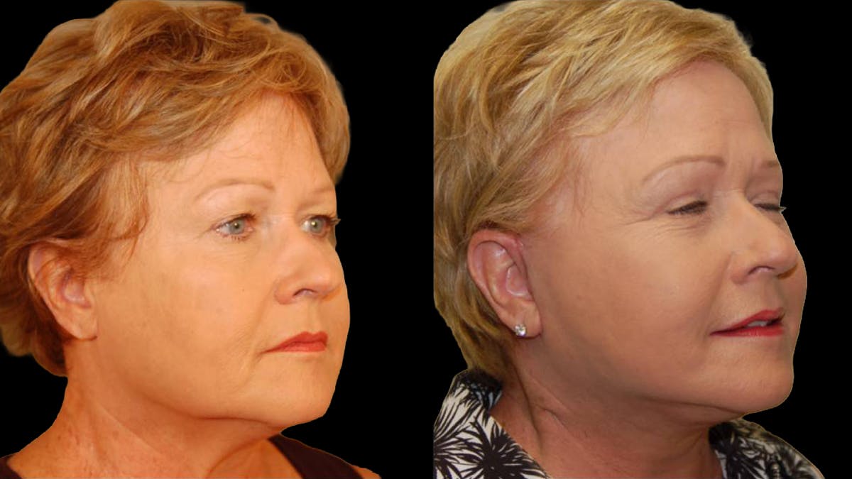 Mini Facelift Before & After Gallery - Patient 352097 - Image 2