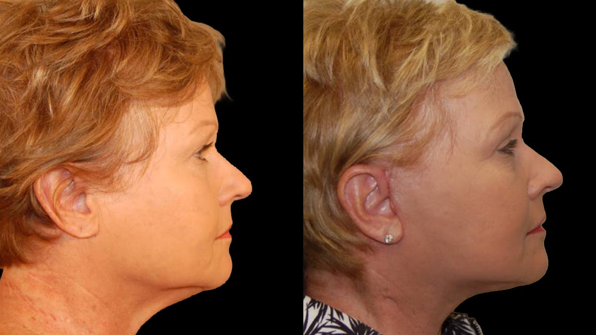 Mini Facelift Before & After Gallery - Patient 352097 - Image 3