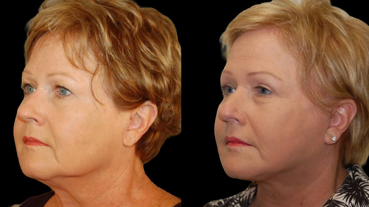Mini Facelift Before & After Gallery - Patient 352097 - Image 4