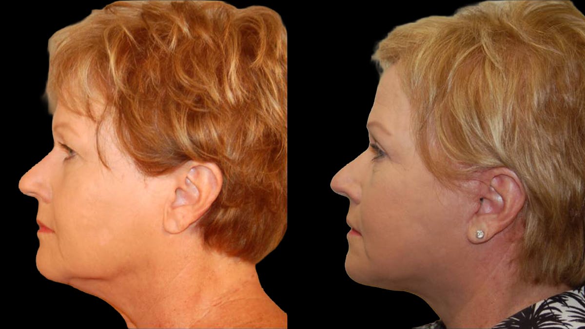 Mini Facelift Before & After Gallery - Patient 352097 - Image 5