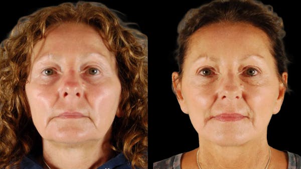 Mini Facelift Before & After Gallery - Patient 333442 - Image 1
