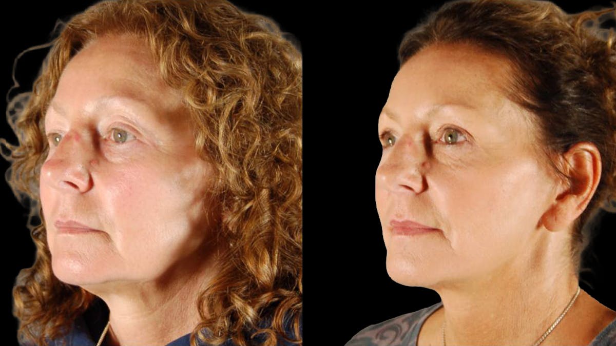 Mini Facelift Before & After Gallery - Patient 333442 - Image 2