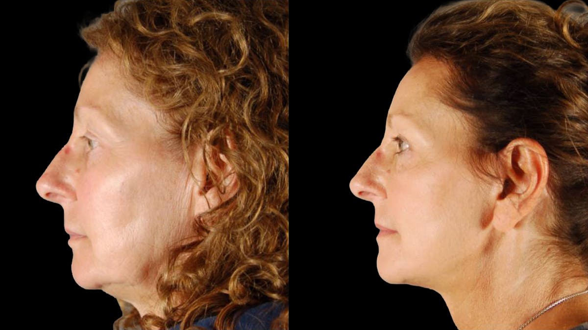 Mini Facelift Before & After Gallery - Patient 333442 - Image 3