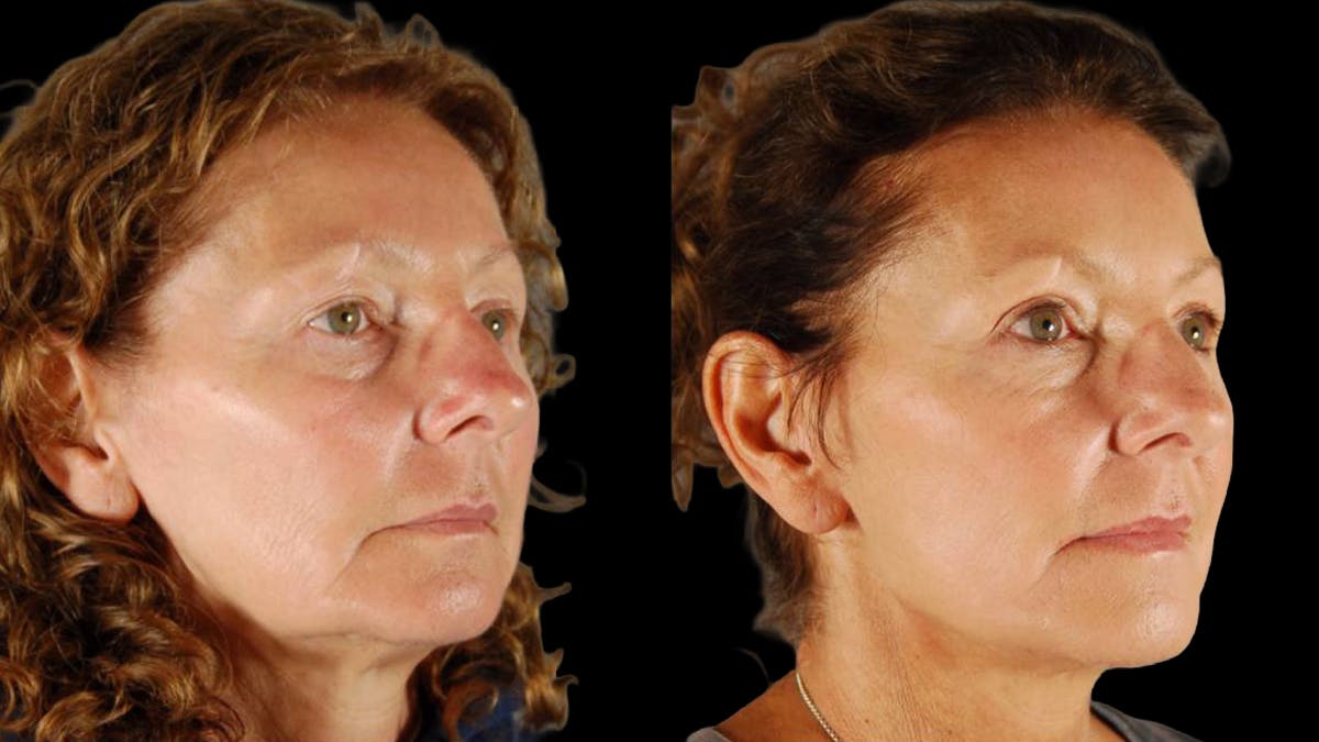 Mini Facelift Before & After Gallery - Patient 333442 - Image 4