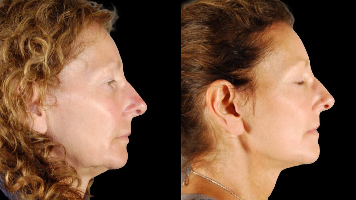 Mini Facelift Before & After Gallery - Patient 333442 - Image 5