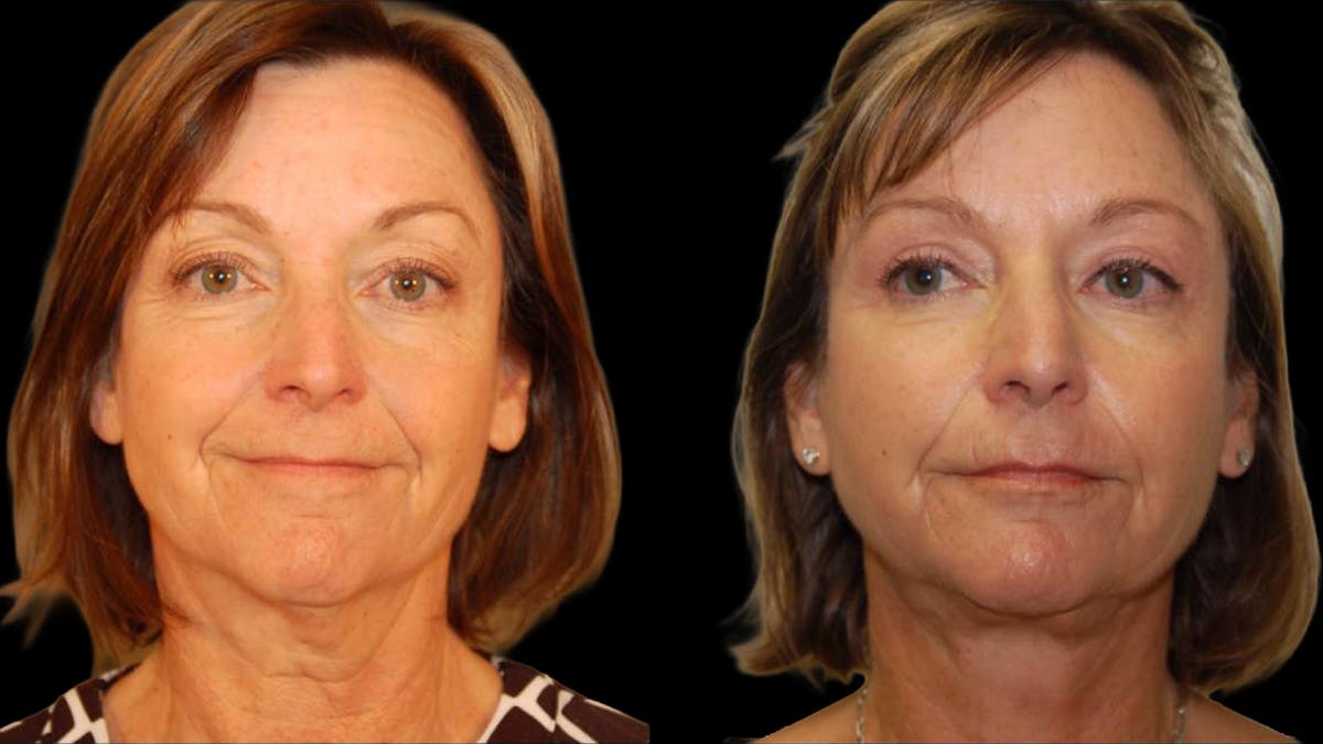 Mini Facelift Before & After Gallery - Patient 402788 - Image 1
