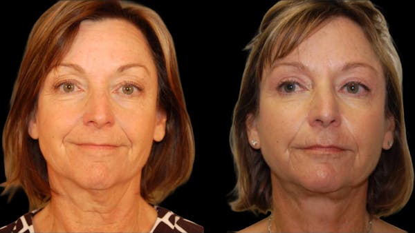 Mini Facelift Before & After Gallery - Patient 402788 - Image 1
