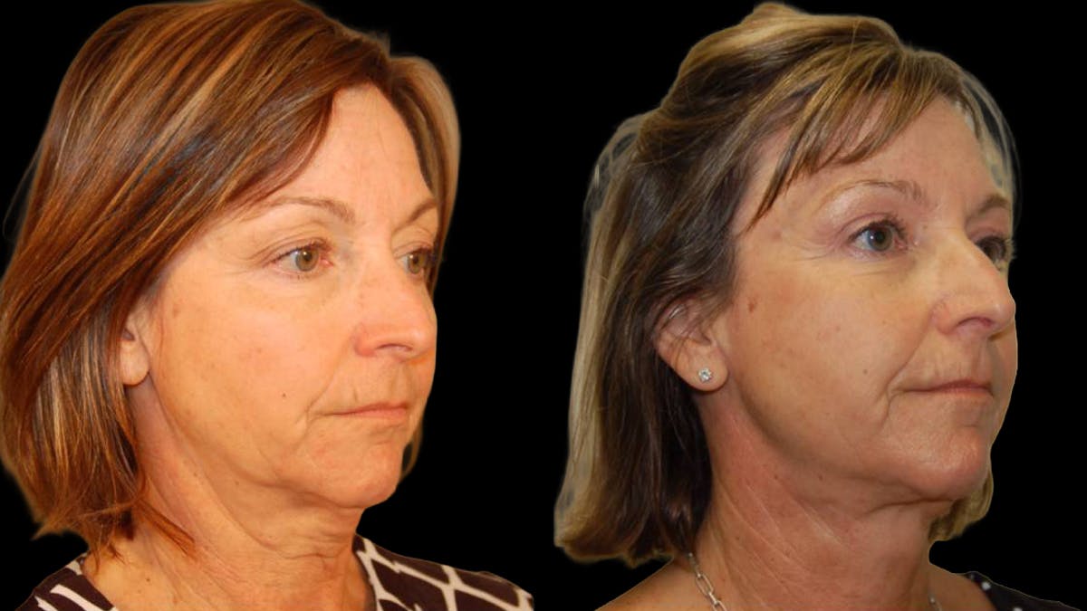 Mini Facelift Before & After Gallery - Patient 402788 - Image 2