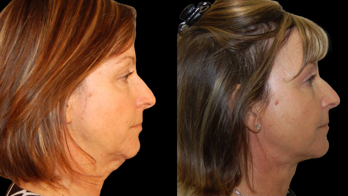Mini Facelift Before & After Gallery - Patient 402788 - Image 3