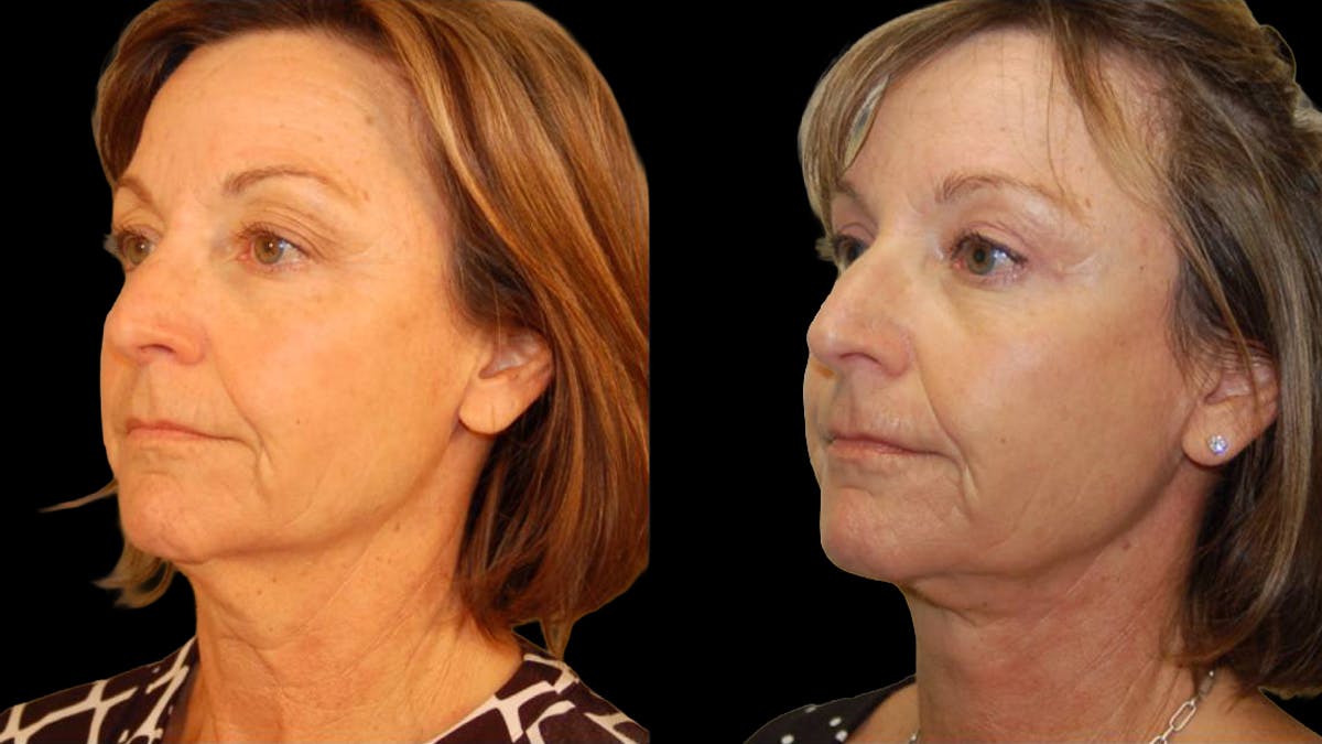 Mini Facelift Before & After Gallery - Patient 402788 - Image 4