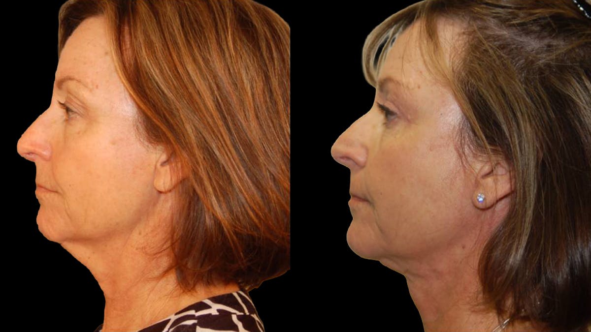 Mini Facelift Before & After Gallery - Patient 402788 - Image 5