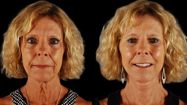 Mini Facelift Before & After Gallery - Patient 347794 - Image 1