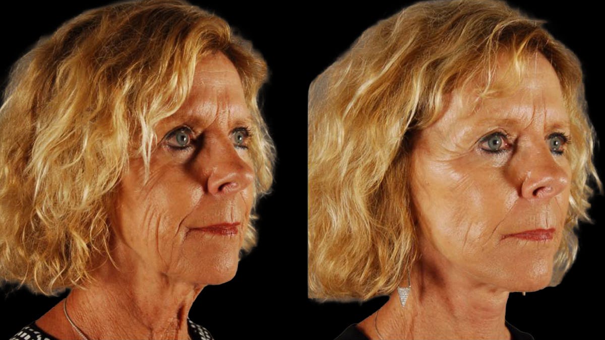 Mini Facelift Before & After Gallery - Patient 347794 - Image 2