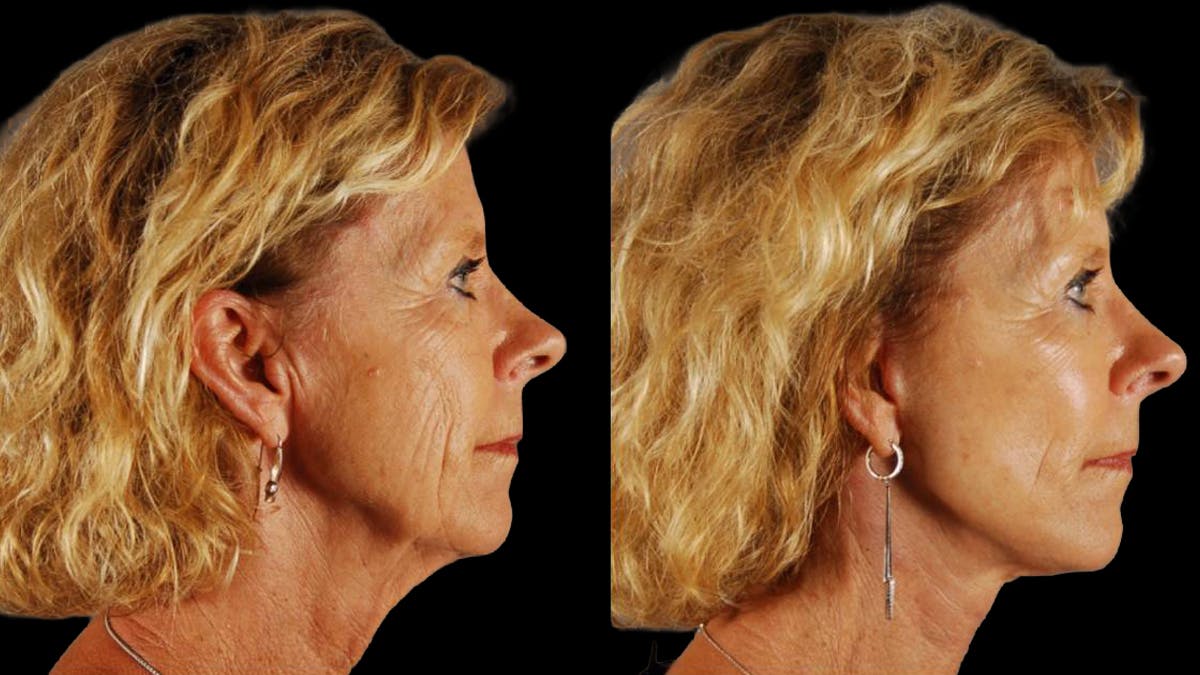 Mini Facelift Before & After Gallery - Patient 347794 - Image 3