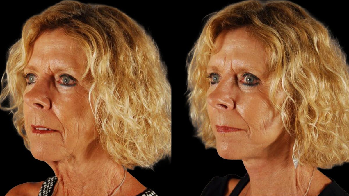 Mini Facelift Before & After Gallery - Patient 347794 - Image 4