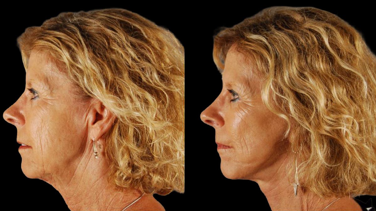 Mini Facelift Before & After Gallery - Patient 347794 - Image 5