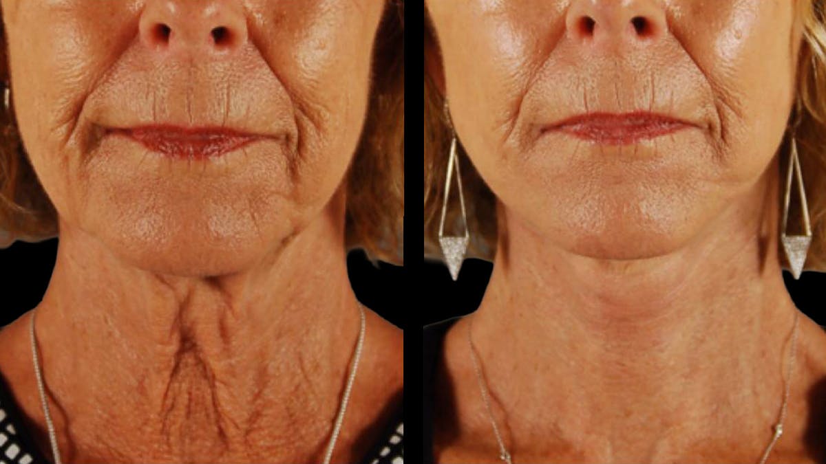 Mini Facelift Before & After Gallery - Patient 347794 - Image 6