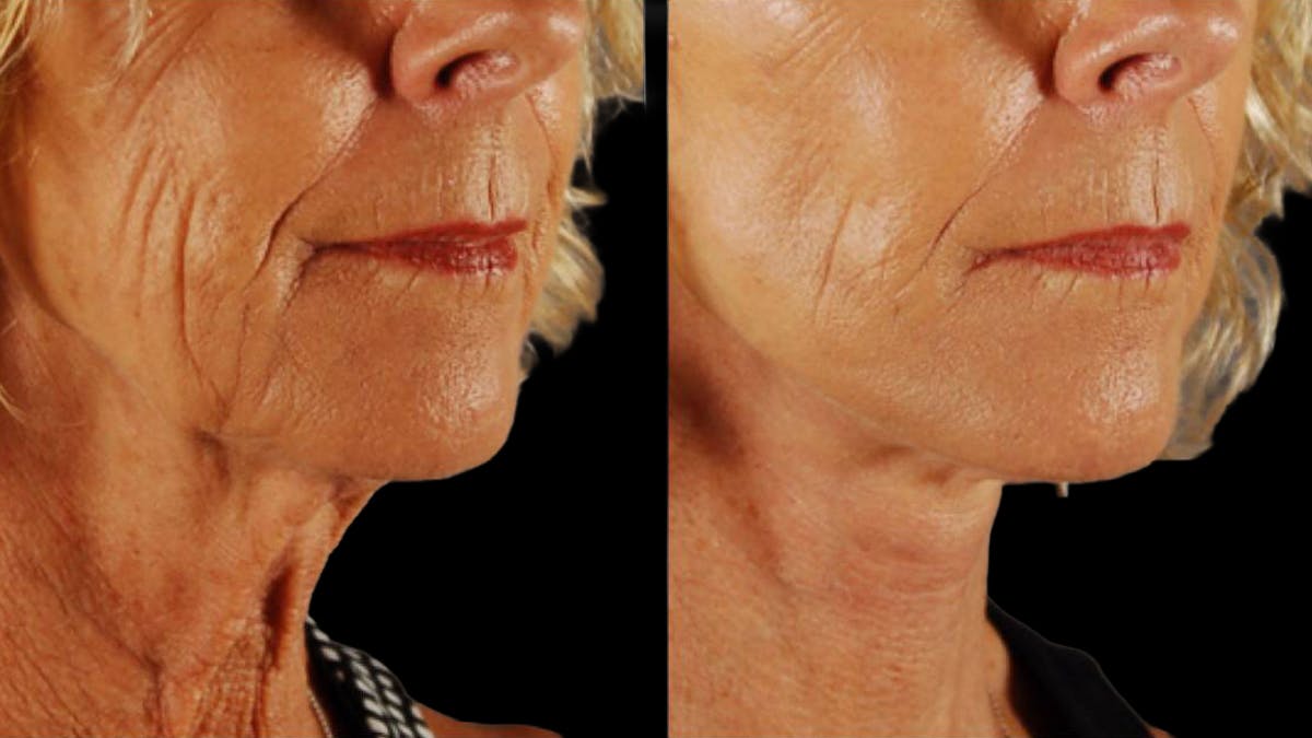 Mini Facelift Before & After Gallery - Patient 347794 - Image 7
