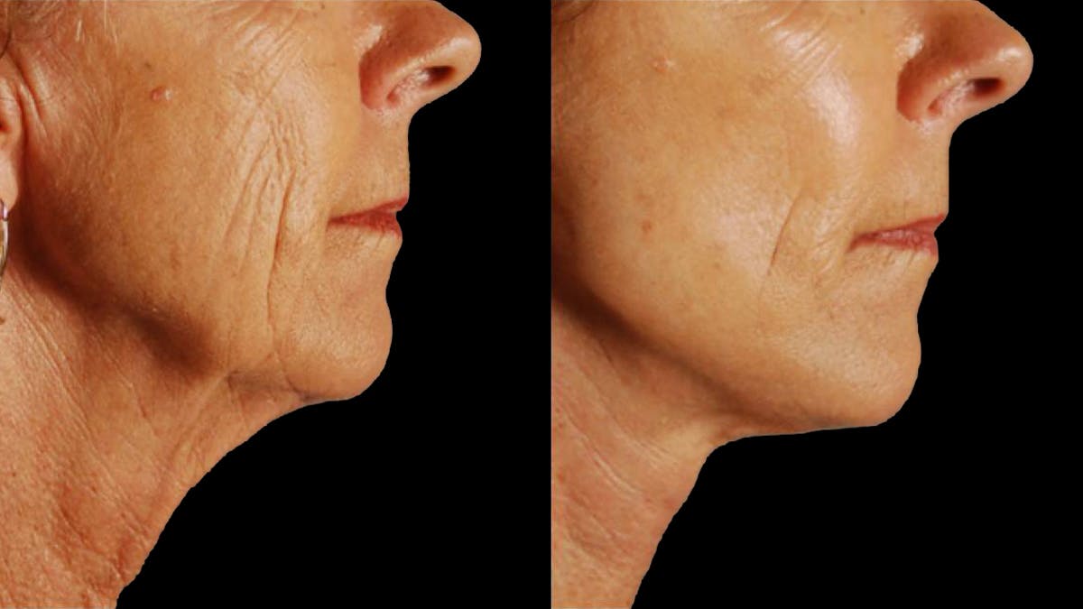 Mini Facelift Before & After Gallery - Patient 347794 - Image 8