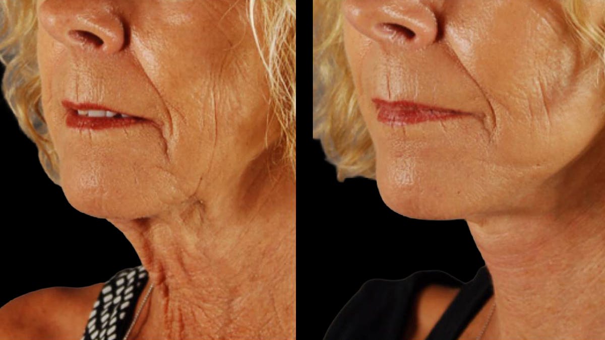 Mini Facelift Before & After Gallery - Patient 347794 - Image 9