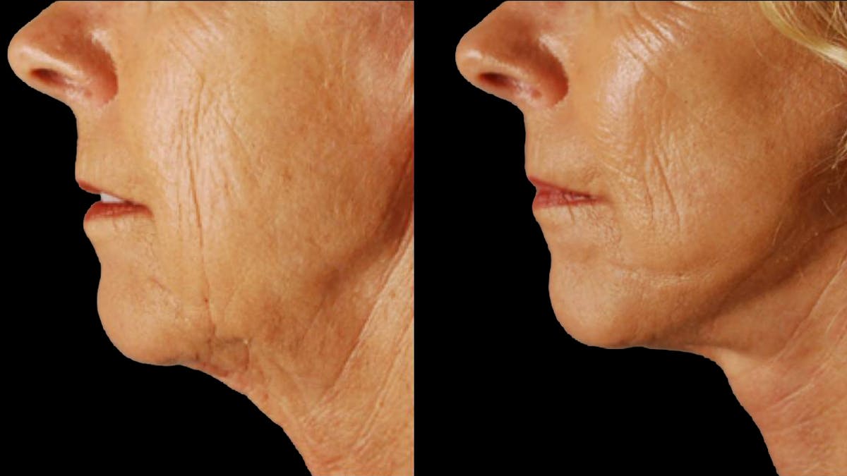 Mini Facelift Before & After Gallery - Patient 347794 - Image 10