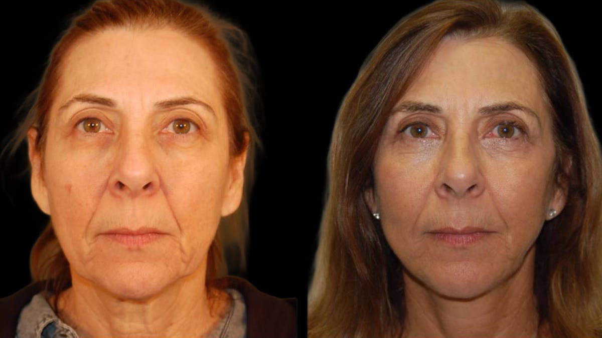Mini Facelift Before & After Gallery - Patient 547755 - Image 1